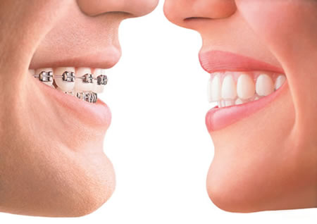 Have Questions about Straightening Teeth with Invisalign? We Have the Answers!