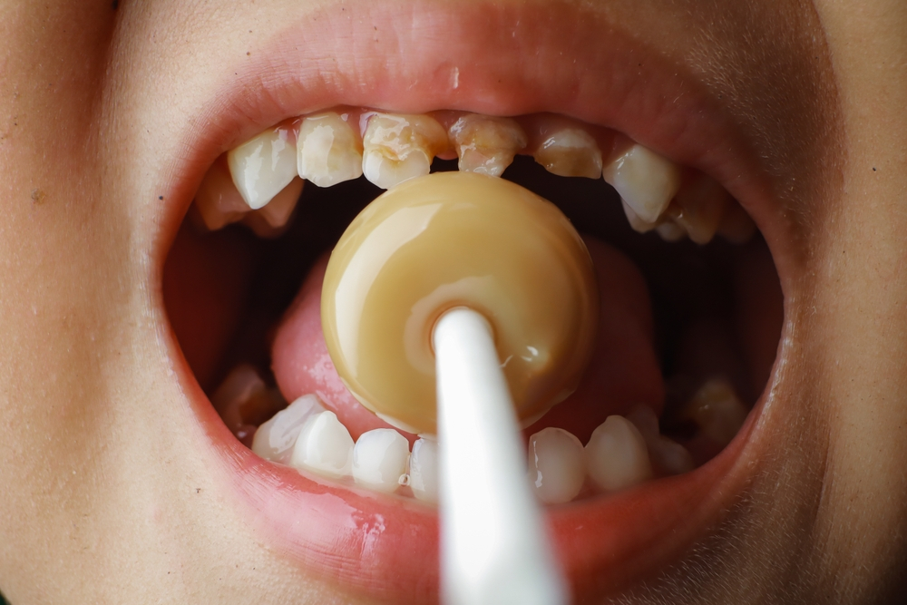 ways to prevent cavities