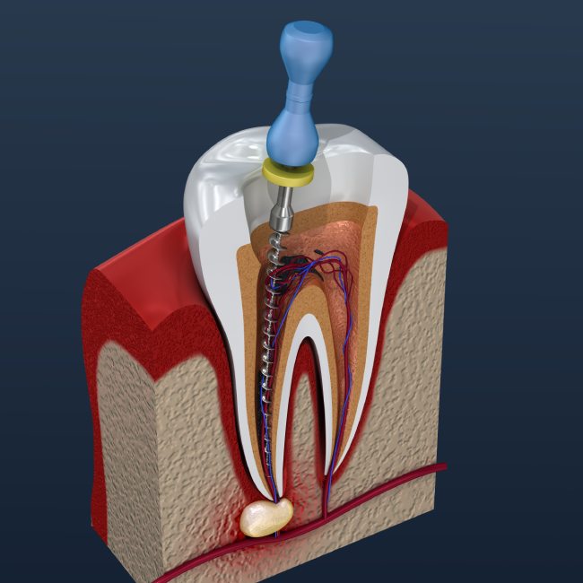 root canals in Coquitlam