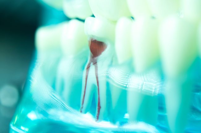 root canals treatment cgs