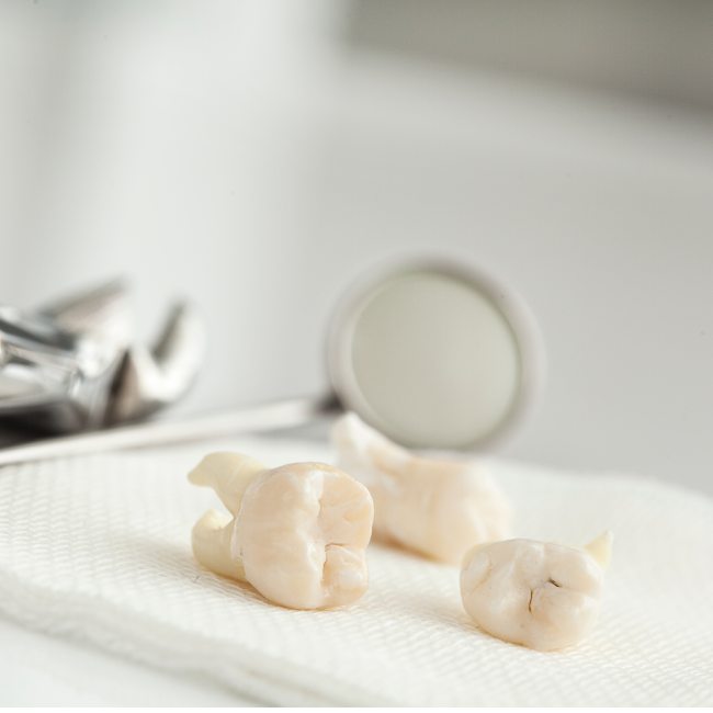 tooth extraction in Coquitlam